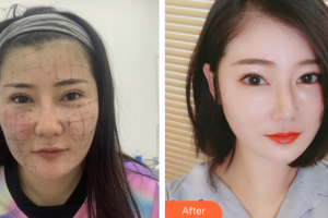 廣州深美醫(yī)療美容門診部曾立整形價格表附熱瑪吉案例展示