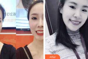 廣州暨博口腔醫(yī)院鐘梅整形價格表附牙齒隱形矯正案例展示