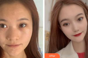 廣州姬妍醫(yī)療美容門診部龔湛整形價格表附鼻部手術(shù)案例展示