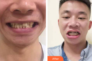 廣州健業(yè)口腔醫(yī)院黃華整形價格表附隱形牙齒矯正案例展示