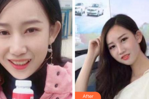 廣州健業(yè)口腔醫(yī)院翁文利整形價格表附牙齒隱形矯正案例展示