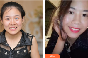 廣州愛康健口腔門診部楊巍華整形價格表附金屬托槽矯正案例展示