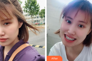 廣州愛康健口腔門診部熊志華整形價格表附金屬托槽牙齒矯正案例展示