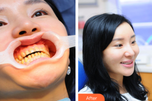 廣州愛康健口腔門診部楊福強(qiáng)整形價(jià)格表附美白貼片案例展示