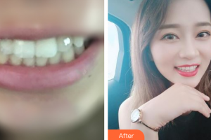 廣州愛康健口腔門診部林露露整形價(jià)格表附金屬托槽矯正案例展示