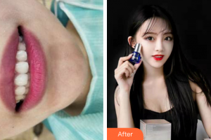 廣州市荔灣區(qū)口腔醫(yī)院趙月萍整形價(jià)格表附隱適美全隱形矯正案例展示