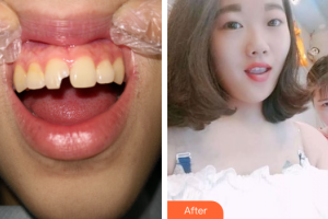 廣州愛康健口腔門診部田振揚(yáng)整形價格表附瓷貼面案例展示