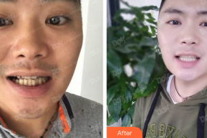 廣州市荔灣區(qū)口腔醫(yī)院黃開清整形價格表附隱形托槽矯正案例展示