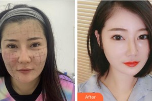 杭州東方整形外科門診部周慎健整形價(jià)格表附熱瑪吉案例展示