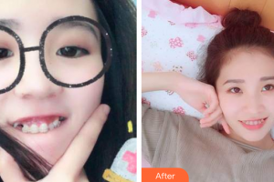 廣州健業(yè)口腔醫(yī)院李友云整形價格表附牙齒矯正案例展示