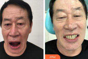 廣州市荔灣區(qū)口腔醫(yī)院謝思明整形價(jià)格表附種植牙案例展示