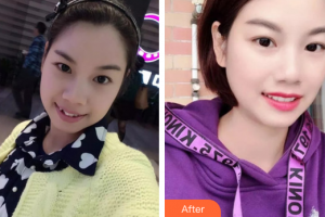 廣州市荔灣區(qū)口腔醫(yī)院趙要武整形價(jià)格表附牙齒矯正案例展示