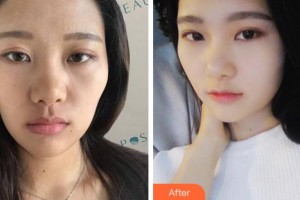 杭州瑞麗整形醫(yī)院賀激光整形醫(yī)師整形價格表附熱瑪吉案例展示