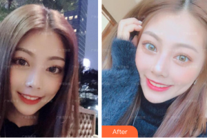 廣州市荔灣區(qū)口腔醫(yī)院王志偉整形價(jià)格表附牙齒美白案例展示