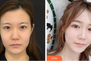 杭州瑞麗整形醫(yī)院劉波整形價格表附熱瑪吉案例展示