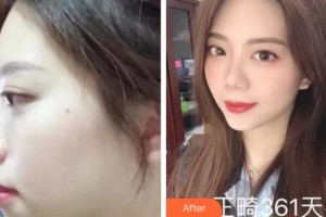 杭州珈禾整形美容醫(yī)院馮應(yīng)宏整形價格表附金屬托槽矯正案例展示