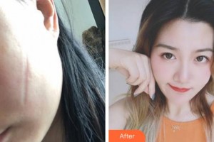 杭州格萊美整形美容醫(yī)院吳枝香整形價格表附激光祛疤案例展示