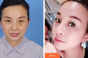 杭州時光醫(yī)療美容醫(yī)院鄒芥整形價格表附埋線提升案例展示