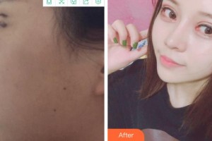 杭州維多利亞醫(yī)療美容醫(yī)院袁宇鋼整形價格表附眼部綜合案例展示