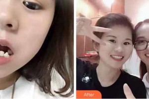 杭州維多利亞醫(yī)療美容醫(yī)院劉吉利整形價格表附牙齒陶瓷矯正案例展示