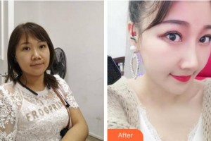 杭州格萊美整形美容醫(yī)院李穎整形價格表附鼻中隔軟骨隆鼻案例展示