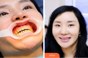 杭州格萊美整形美容醫(yī)院李東燦整形價格表附美白貼片案例展示