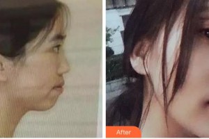 杭州愛琴海醫(yī)療美容醫(yī)院馬奇整形價格表附金屬托槽矯正案例展示