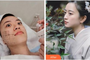 杭州愛琴海醫(yī)療美容醫(yī)院朱金土整形價格表附熱瑪吉案例展示