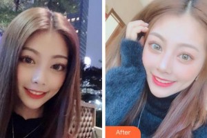 杭州愛琴海醫(yī)療美容醫(yī)院方剛整形價格表附冷光美白案例展示