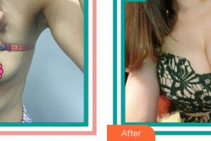 杭州邵逸夫醫(yī)院整形美容中心邵雁整形價格表附自體脂肪隆胸案例展示