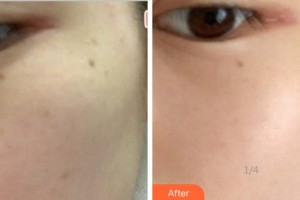 杭州時光醫(yī)療美容醫(yī)院張壽麗整形價格表附激光祛斑案例展示