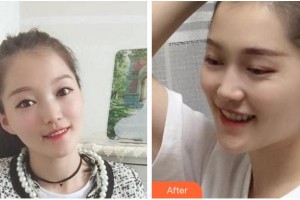 杭州時光醫(yī)療美容醫(yī)院茅來發(fā)整形價格表附金屬托槽矯正案例展示