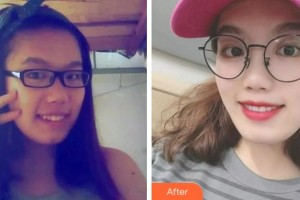 杭州華山連天美醫(yī)療美容整形醫(yī)院陳海濱整形價格表附隱形托槽矯正案例展示