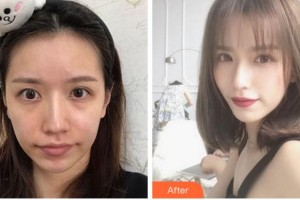 杭州華山連天美醫(yī)療美容整形醫(yī)院柳盈整形價格表附埋線提升案例展示