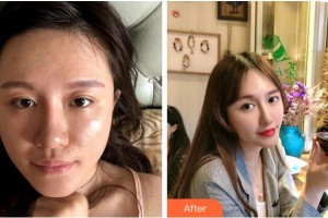 杭州華山連天美醫(yī)療美容整形醫(yī)院李斌斌整形價格表附埋線提升案例展示