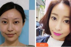 杭州整形醫(yī)院孫豪整形價(jià)格表附埋線提升案例展示