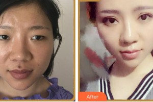 杭州整形醫(yī)院林潔整形價(jià)格表附眼部綜合案例展示