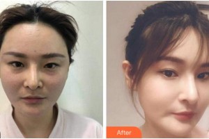 杭州整形醫(yī)院田楓整形價(jià)格表附埋線提升案例展示