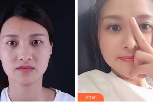 杭州整形醫(yī)院唐冬生整形價(jià)格表附眼部綜合案例展示