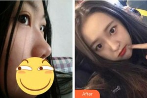 杭州整形醫(yī)院張占召整形價(jià)格表附肋軟骨隆鼻案例展示