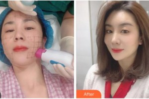 杭州王圣林美容整形診所王圣林整形價(jià)格表附熱瑪吉案例展示