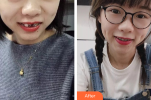 廣州市荔灣區(qū)口腔醫(yī)院溫興濤整形價(jià)格表附金屬托槽矯正案例展示