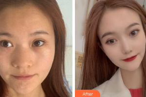 廣州美博匯醫(yī)療美容門診部黃祖成整形價(jià)格表附鼻部手術(shù)案例展示