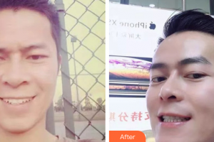 廣州市荔灣區(qū)口腔醫(yī)院張娟整形價(jià)格表附牙齒矯正案例展示