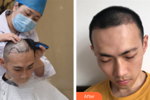 廣州美博匯醫(yī)療美容門診部羅科義整形價(jià)格表附植發(fā)案例展示