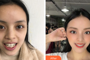 廣州市荔灣區(qū)口腔醫(yī)院鄒雙雙整形價格表附隱形牙齒矯正案例展示