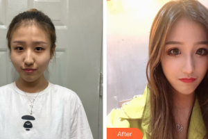 廣州曙光醫(yī)學(xué)美容醫(yī)院范丹整形價(jià)格表附顴骨顴弓案例展示