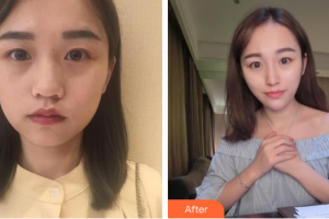 廣州可玉醫(yī)療美容門診部劉瑤整形價(jià)格表附熱瑪吉多方面部體驗(yàn)案例展示