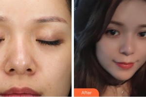 杭州東方整形外科門診部萬(wàn)夢(mèng)華整形價(jià)格表附熱拉提案例展示