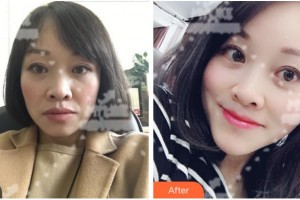 杭州啟美醫(yī)療美容醫(yī)院秦良忠整形價(jià)格表附埋線提升案例展示